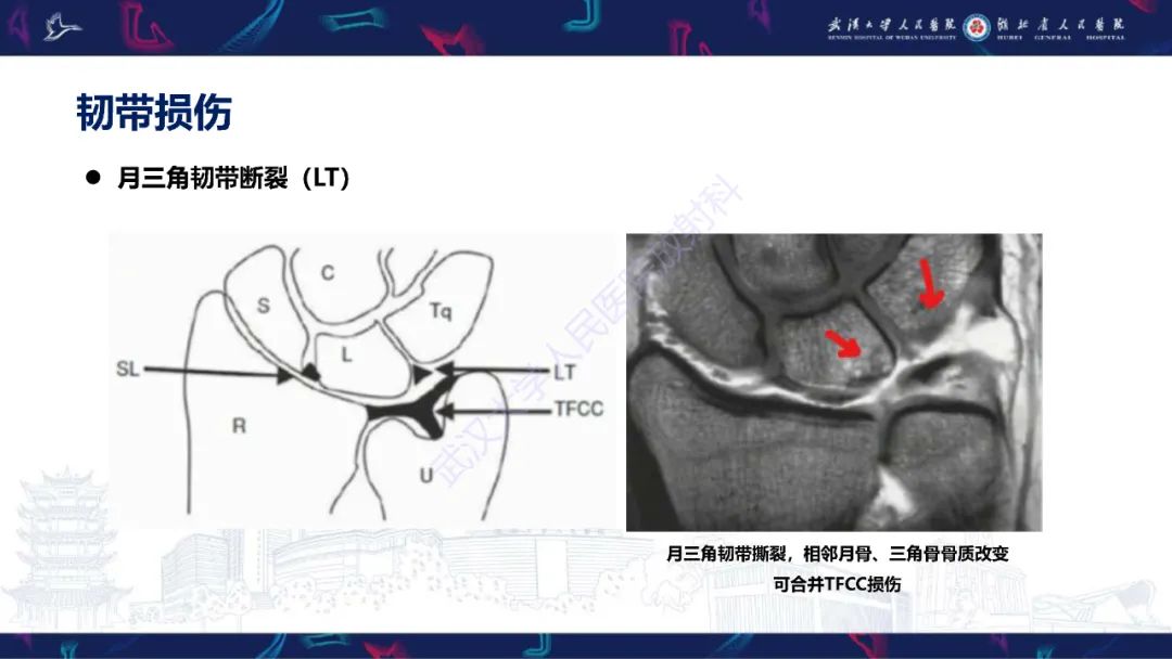 影像PPT - 【PPT】腕关节疼痛MRI评估-12