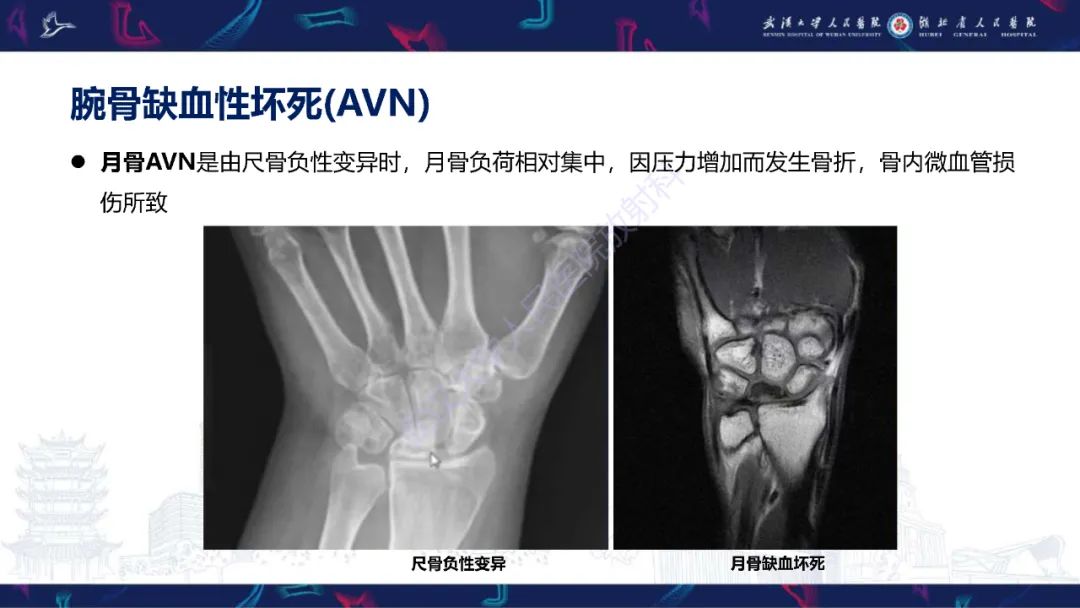 影像PPT - 【PPT】腕关节疼痛MRI评估-14