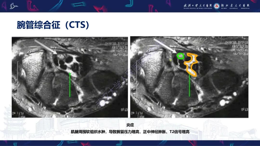 影像PPT - 【PPT】腕关节疼痛MRI评估-18