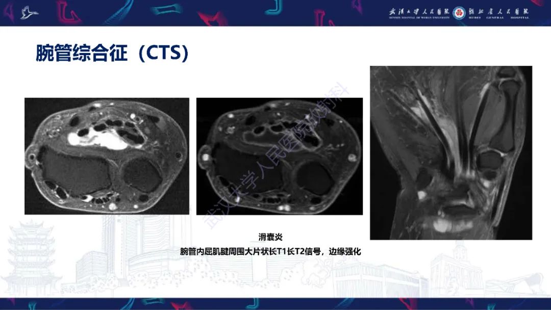 影像PPT - 【PPT】腕关节疼痛MRI评估-19