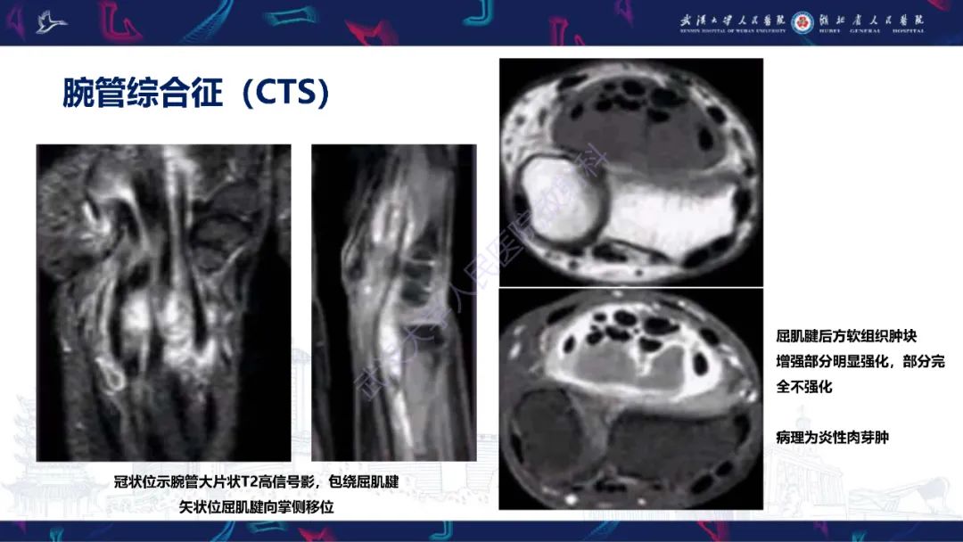 影像PPT - 【PPT】腕关节疼痛MRI评估-20