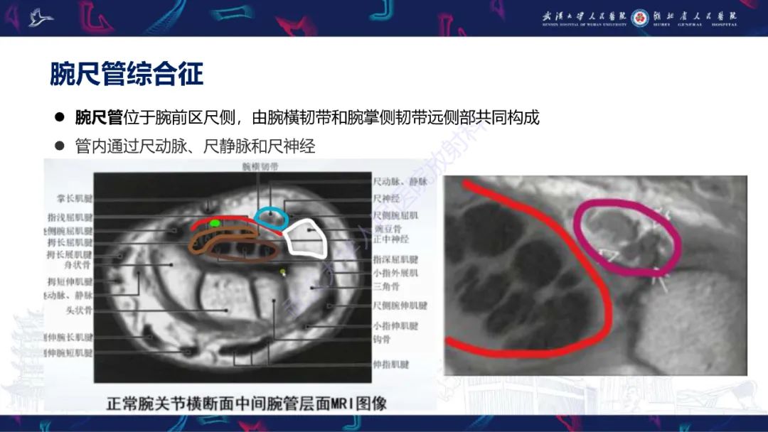 影像PPT - 【PPT】腕关节疼痛MRI评估-22