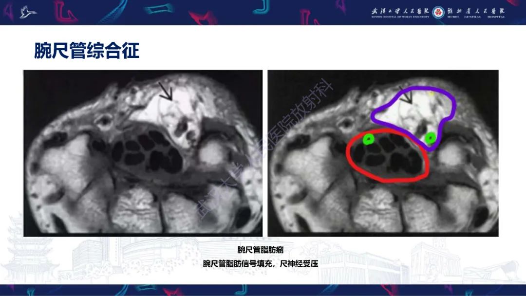 影像PPT - 【PPT】腕关节疼痛MRI评估-23