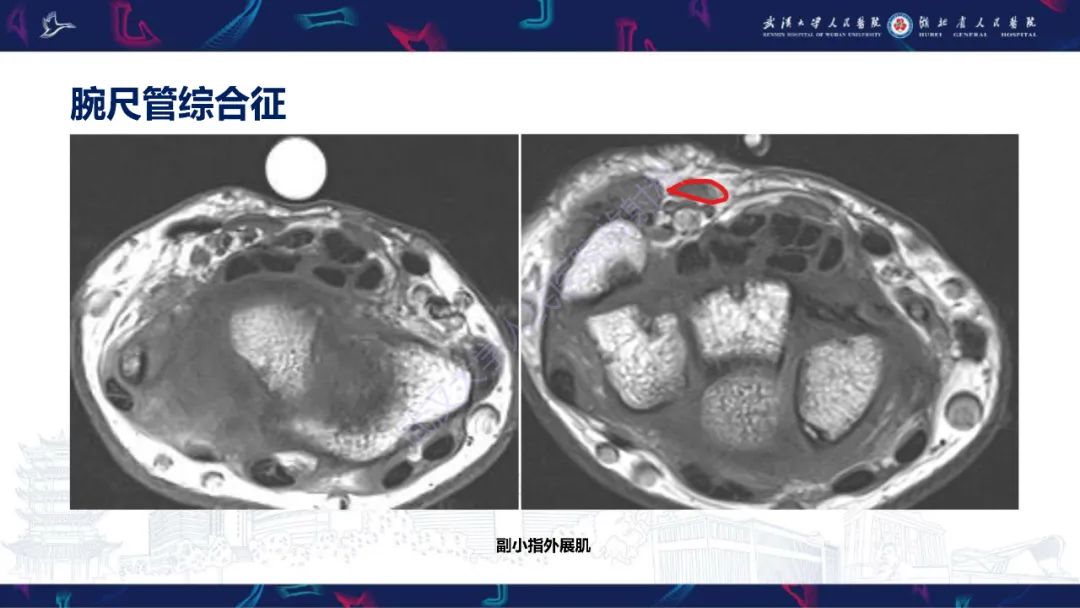 影像PPT - 【PPT】腕关节疼痛MRI评估-24