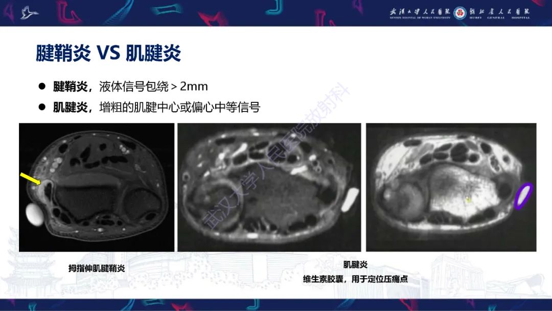 影像PPT - 【PPT】腕关节疼痛MRI评估-25