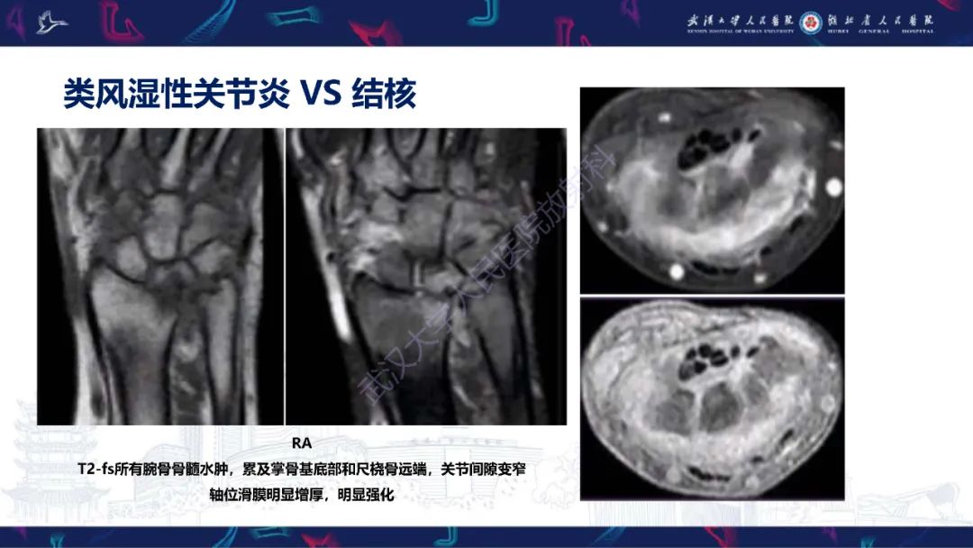 影像PPT - 【PPT】腕关节疼痛MRI评估-26
