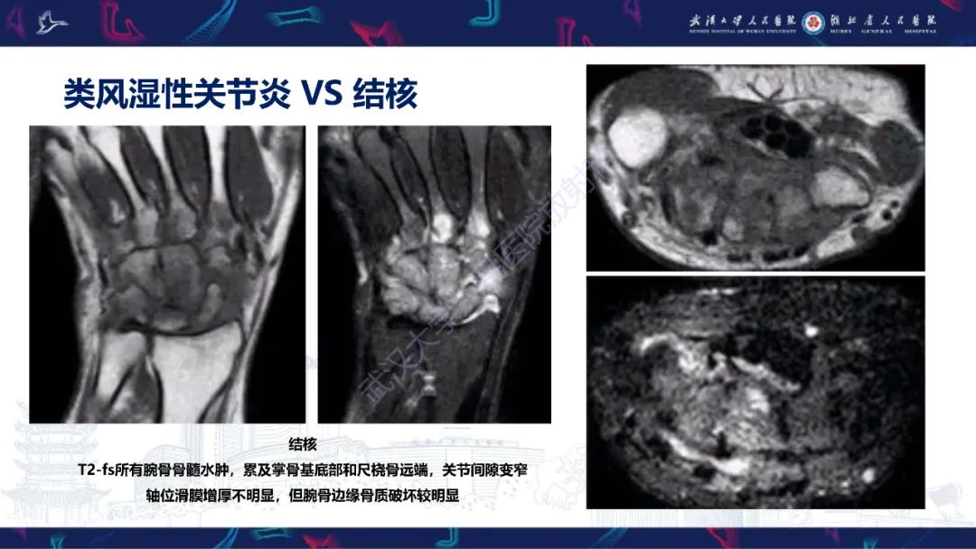 影像PPT - 【PPT】腕关节疼痛MRI评估-27