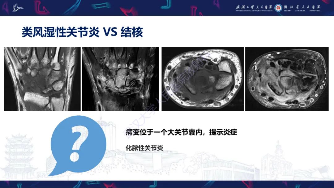 影像PPT - 【PPT】腕关节疼痛MRI评估-28