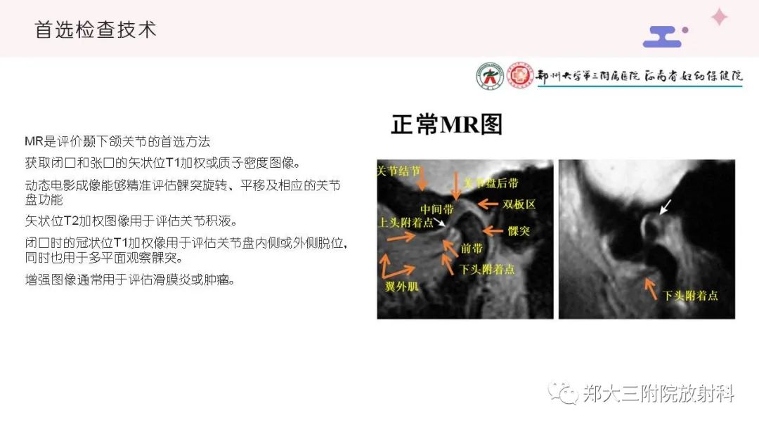 影像PPT - 【PPT】颞下颌关节紊乱的影像学表现-11