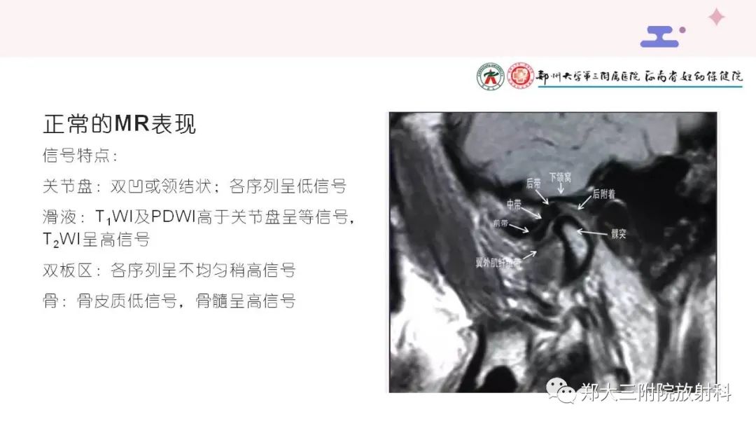 影像PPT - 【PPT】颞下颌关节紊乱的影像学表现-12