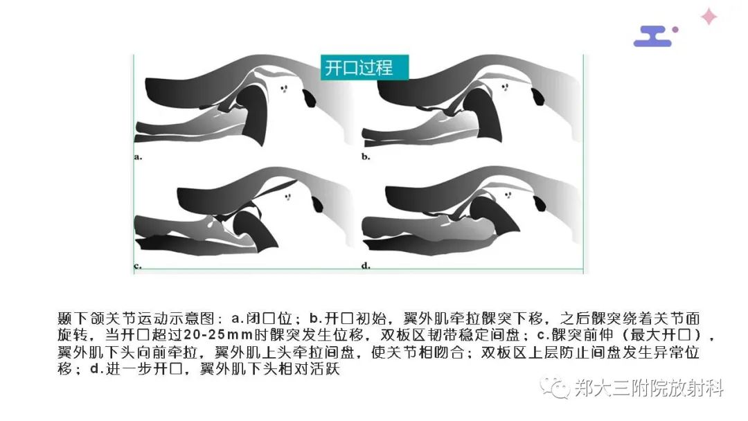 影像PPT - 【PPT】颞下颌关节紊乱的影像学表现-18