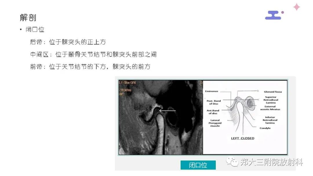 影像PPT - 【PPT】颞下颌关节紊乱的影像学表现-13