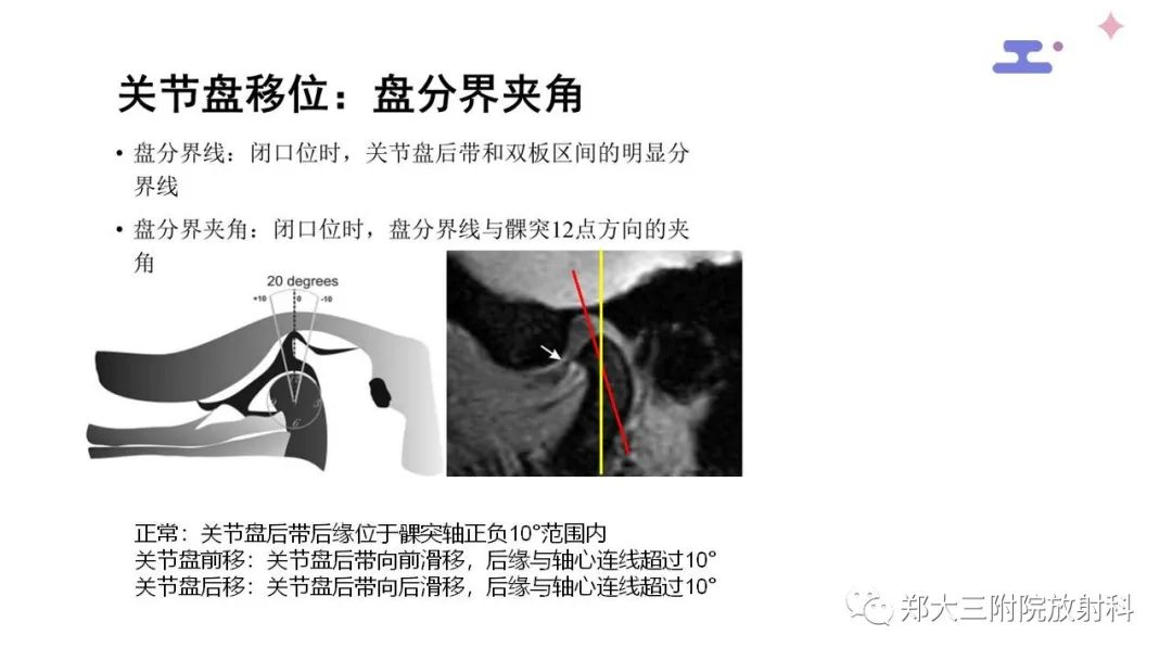 影像PPT - 【PPT】颞下颌关节紊乱的影像学表现-16