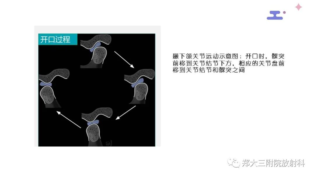 影像PPT - 【PPT】颞下颌关节紊乱的影像学表现-17