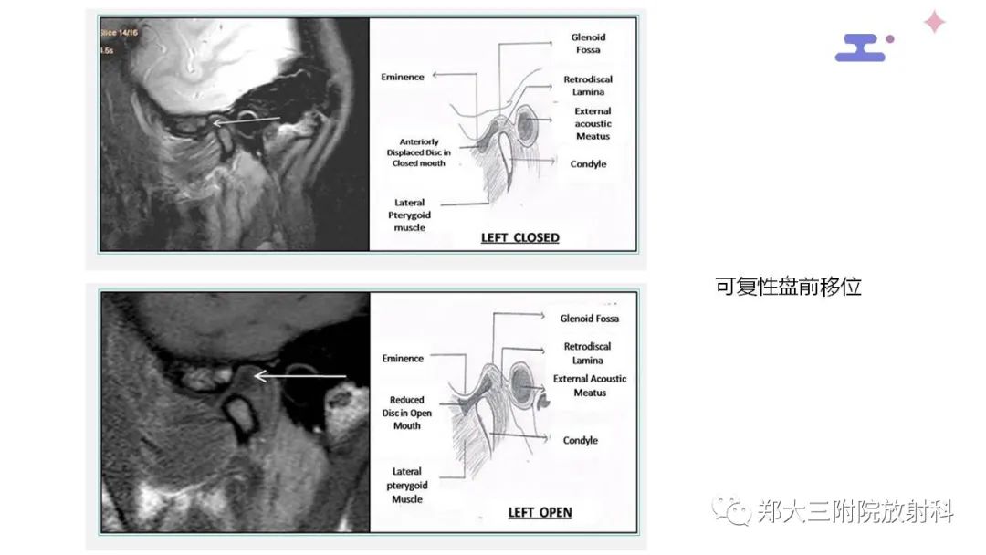 影像PPT - 【PPT】颞下颌关节紊乱的影像学表现-23