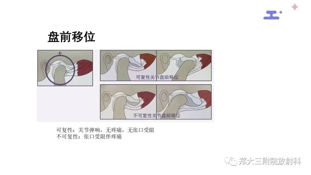 影像PPT - 【PPT】颞下颌关节紊乱的影像学表现-22