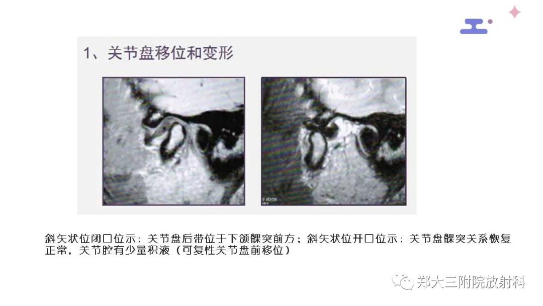 影像PPT - 【PPT】颞下颌关节紊乱的影像学表现-25