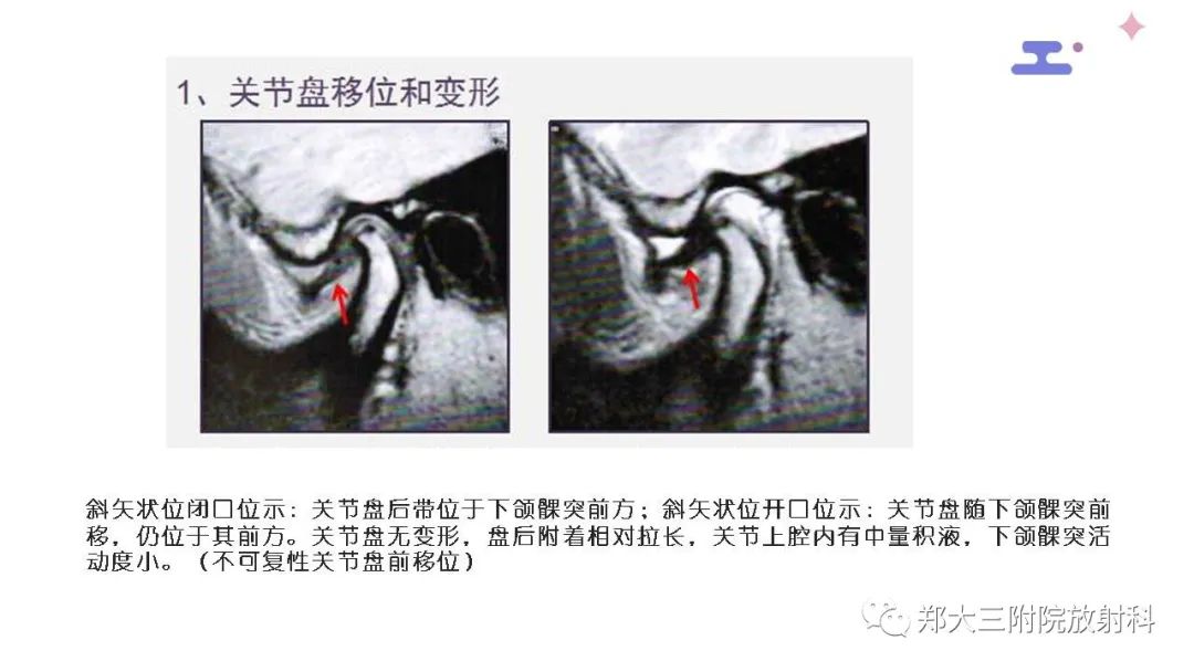 影像PPT - 【PPT】颞下颌关节紊乱的影像学表现-26