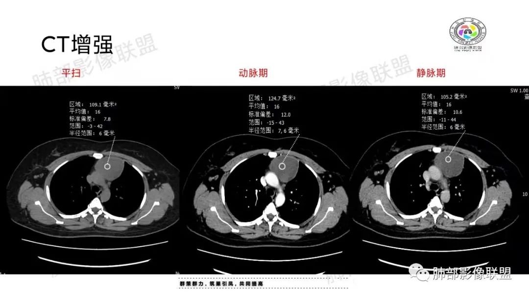 影像PPT - 【病例】纵隔成熟型囊性畸胎瘤1例CT-10 影像PPT - 【病例】纵隔成熟型囊性畸胎瘤1例CT-10