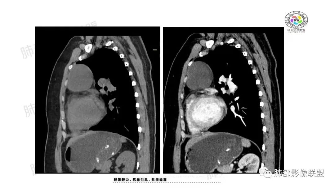 影像PPT - 【病例】纵隔成熟型囊性畸胎瘤1例CT-12 影像PPT - 【病例】纵隔成熟型囊性畸胎瘤1例CT-12