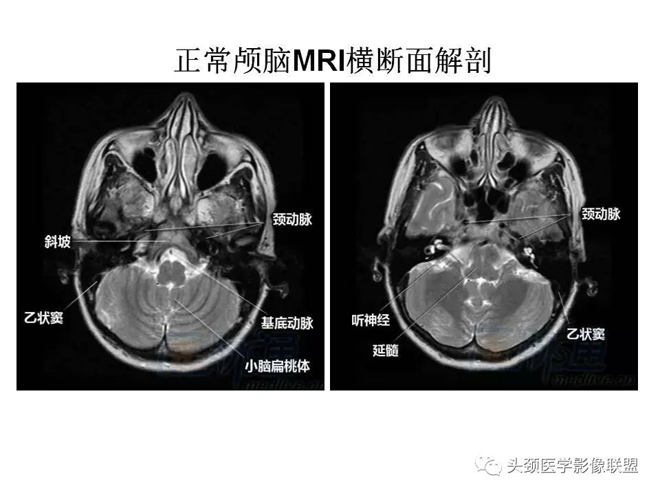 影像PPT - 【PPT】颅脑解剖及血管性病变的MRI诊断-2