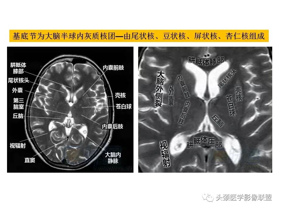 影像PPT - 【PPT】颅脑解剖及血管性病变的MRI诊断-6