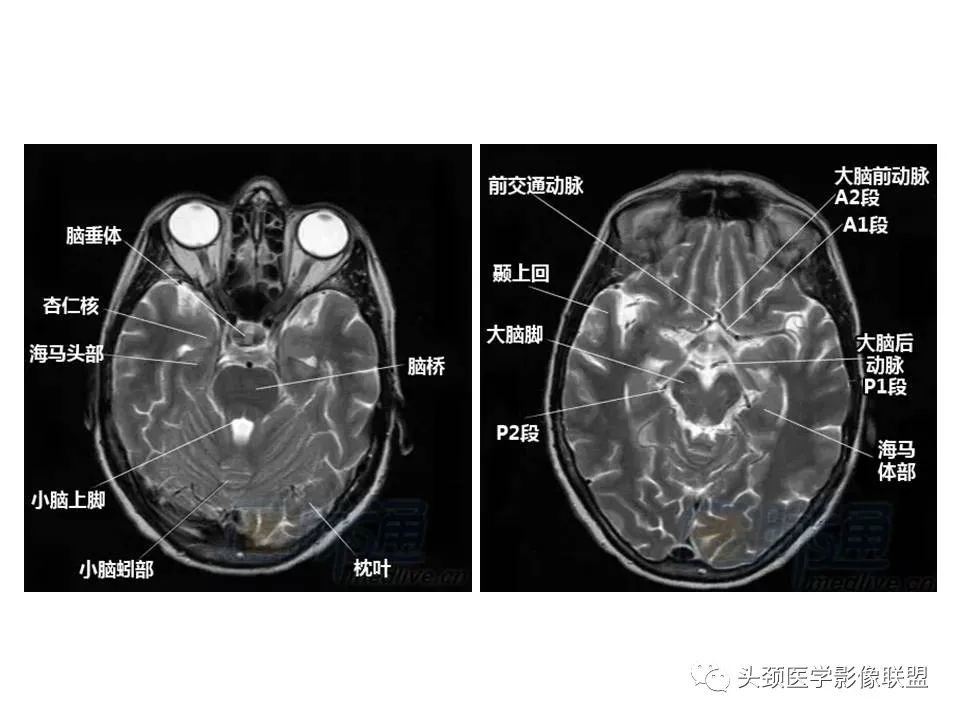 影像PPT - 【PPT】颅脑解剖及血管性病变的MRI诊断-4