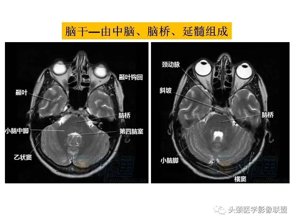 影像PPT - 【PPT】颅脑解剖及血管性病变的MRI诊断-3