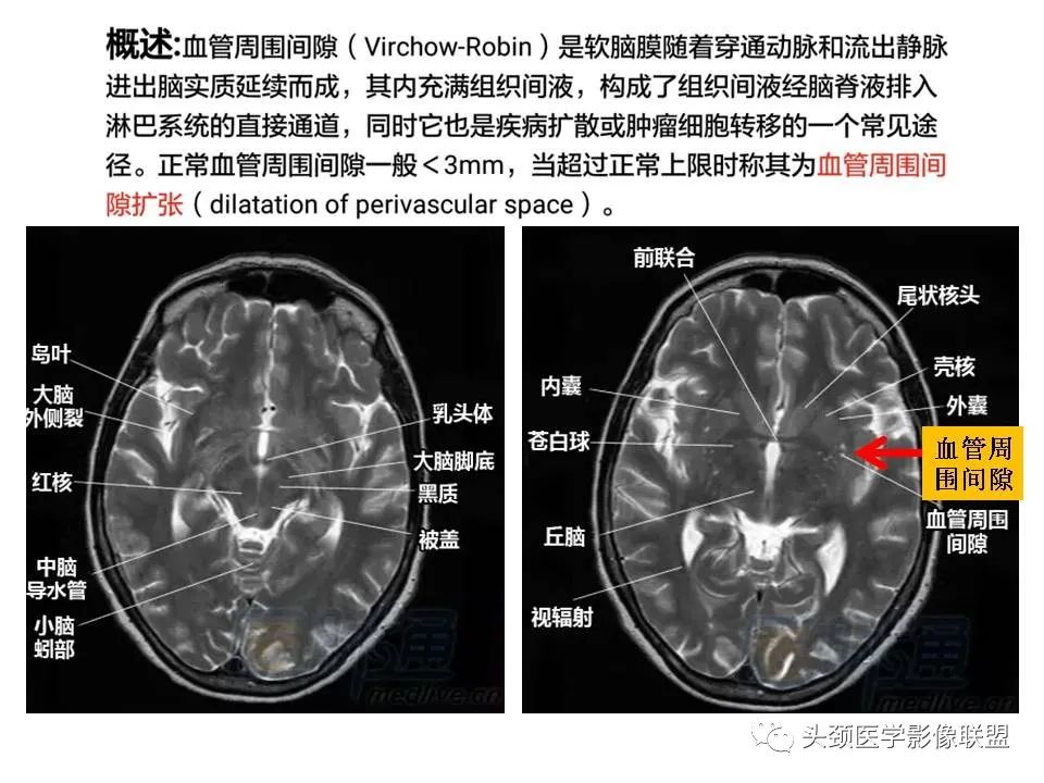 影像PPT - 【PPT】颅脑解剖及血管性病变的MRI诊断-5