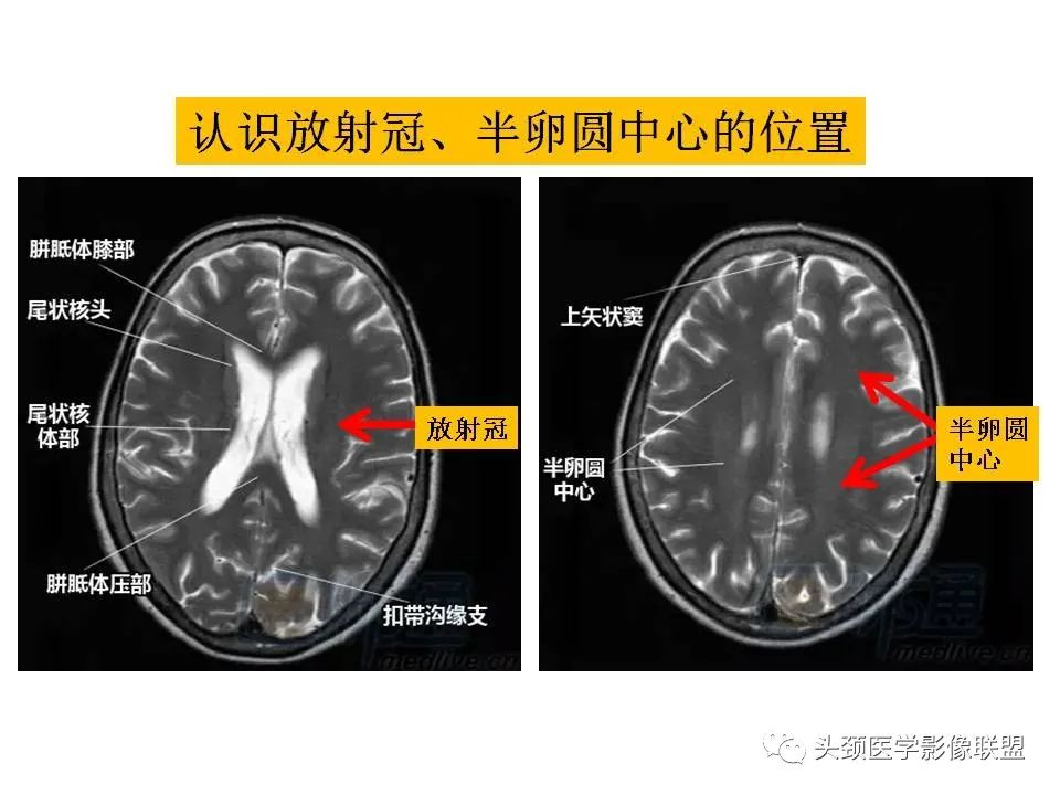 影像PPT - 【PPT】颅脑解剖及血管性病变的MRI诊断-7