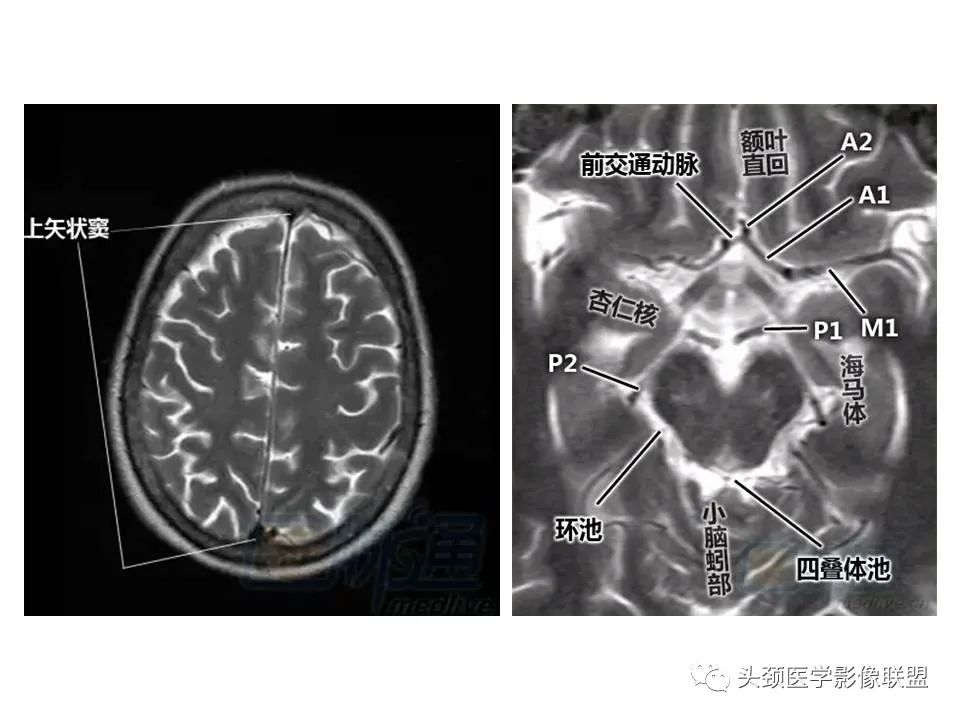 影像PPT - 【PPT】颅脑解剖及血管性病变的MRI诊断-8
