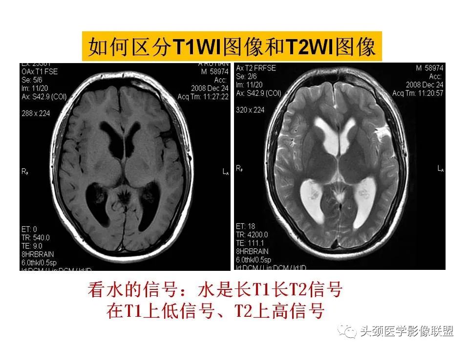 影像PPT - 【PPT】颅脑解剖及血管性病变的MRI诊断-13
