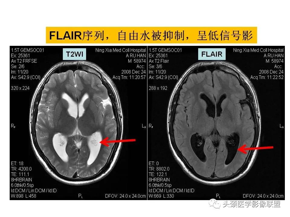 影像PPT - 【PPT】颅脑解剖及血管性病变的MRI诊断-14
