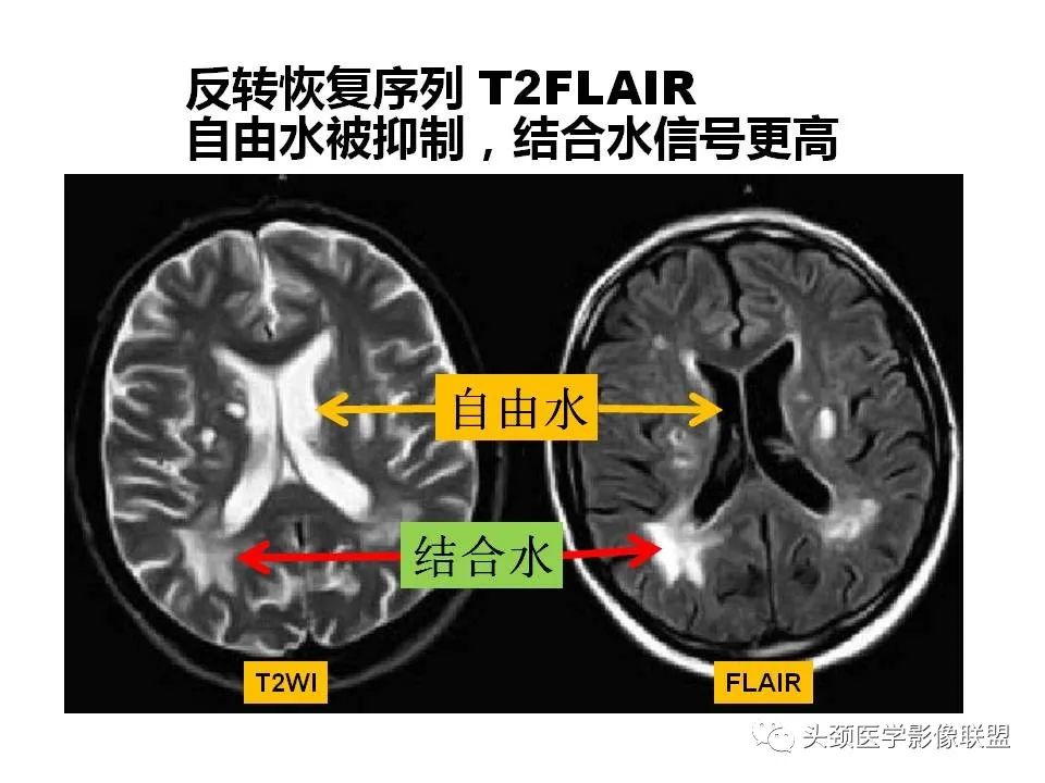 影像PPT - 【PPT】颅脑解剖及血管性病变的MRI诊断-15