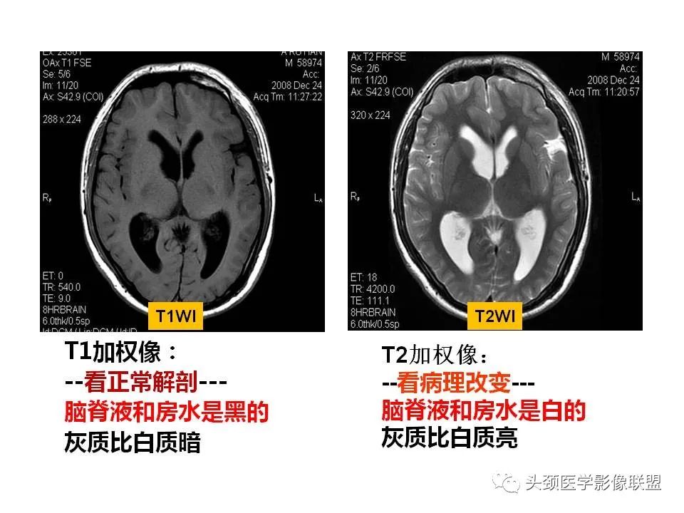 影像PPT - 【PPT】颅脑解剖及血管性病变的MRI诊断-16