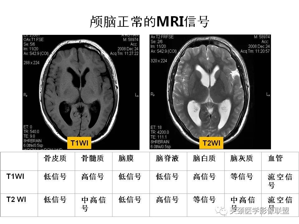 影像PPT - 【PPT】颅脑解剖及血管性病变的MRI诊断-17