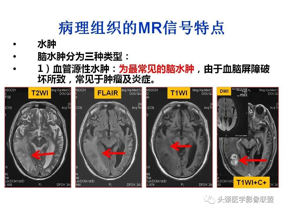 影像PPT - 【PPT】颅脑解剖及血管性病变的MRI诊断-24