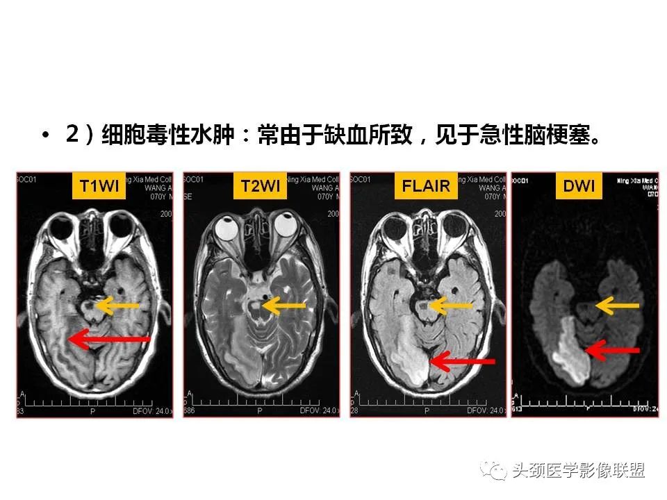 影像PPT - 【PPT】颅脑解剖及血管性病变的MRI诊断-25