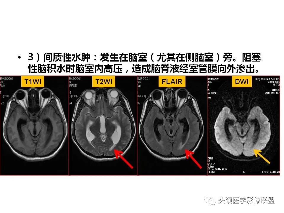 影像PPT - 【PPT】颅脑解剖及血管性病变的MRI诊断-26