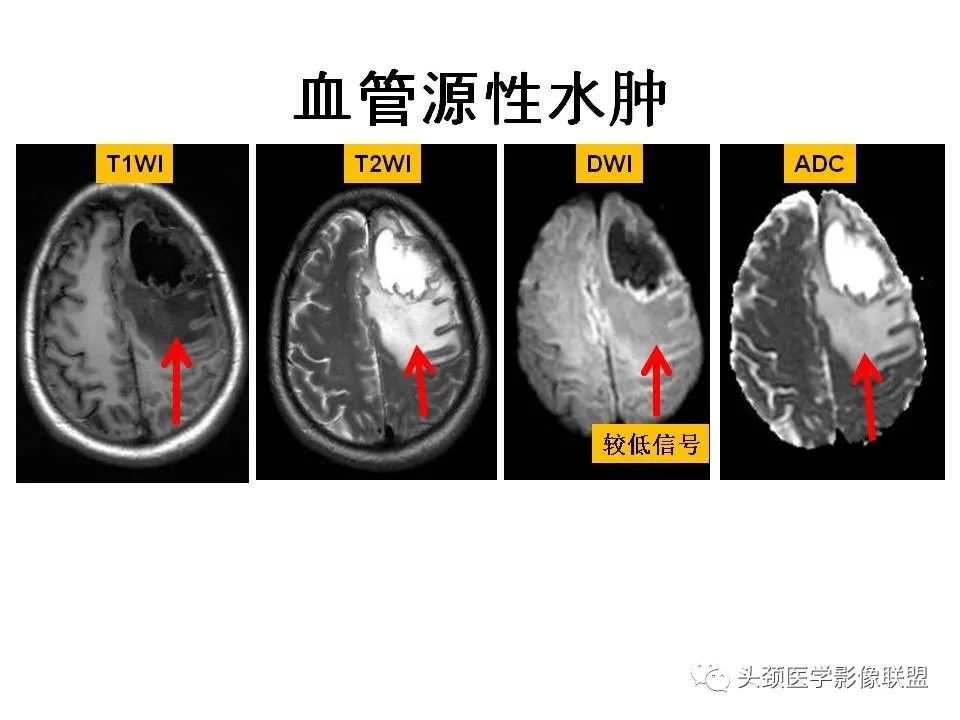 影像PPT - 【PPT】颅脑解剖及血管性病变的MRI诊断-27