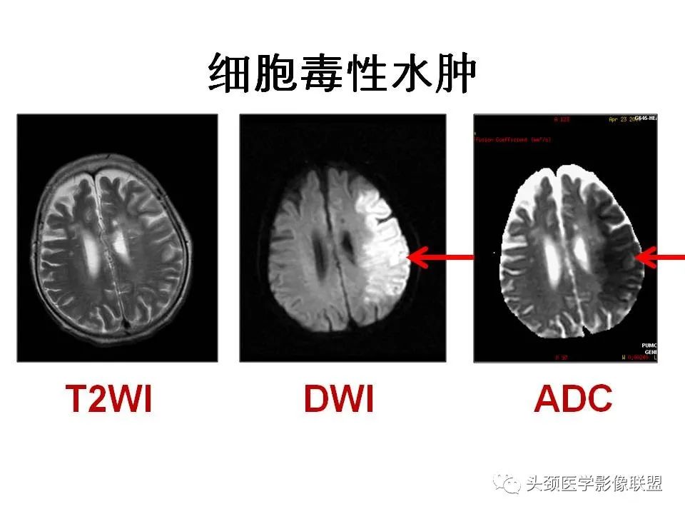 影像PPT - 【PPT】颅脑解剖及血管性病变的MRI诊断-28