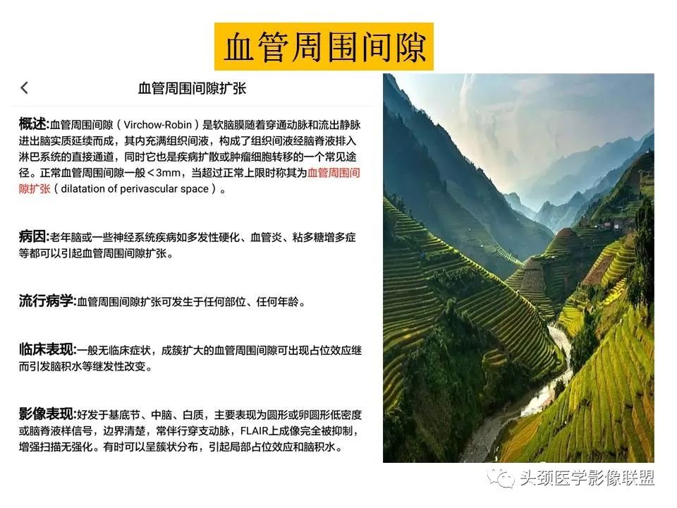 影像PPT - 【PPT】颅脑解剖及血管性病变的MRI诊断-29
