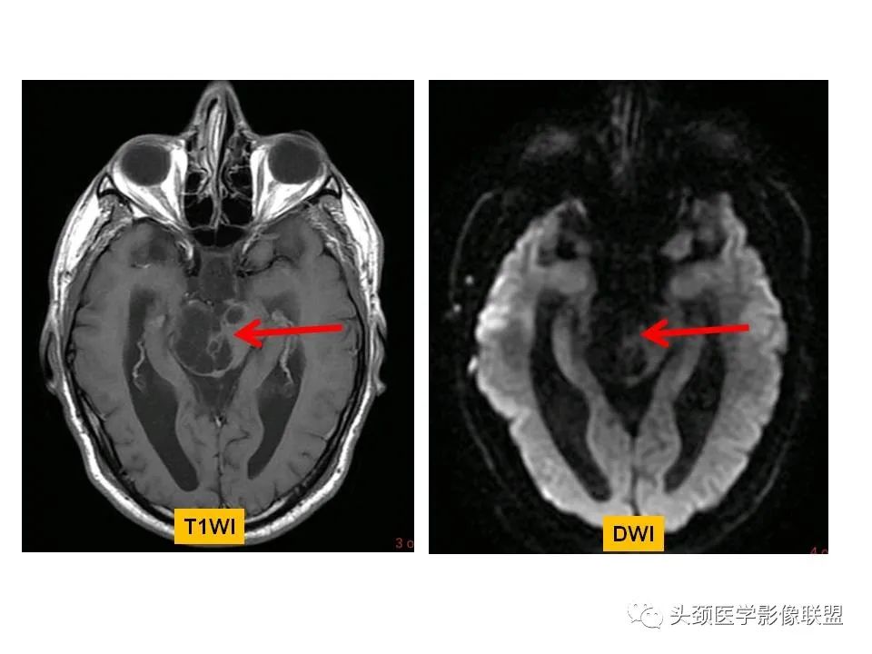 影像PPT - 【PPT】颅脑解剖及血管性病变的MRI诊断-31