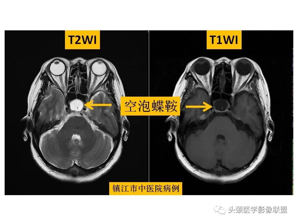影像PPT - 【PPT】颅脑解剖及血管性病变的MRI诊断-33