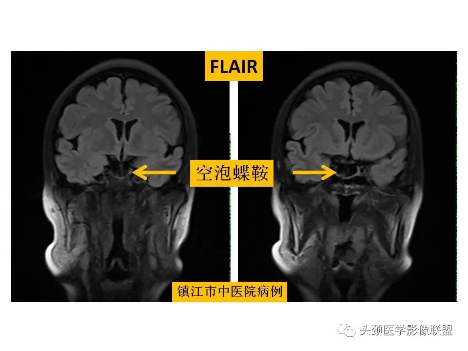 影像PPT - 【PPT】颅脑解剖及血管性病变的MRI诊断-34