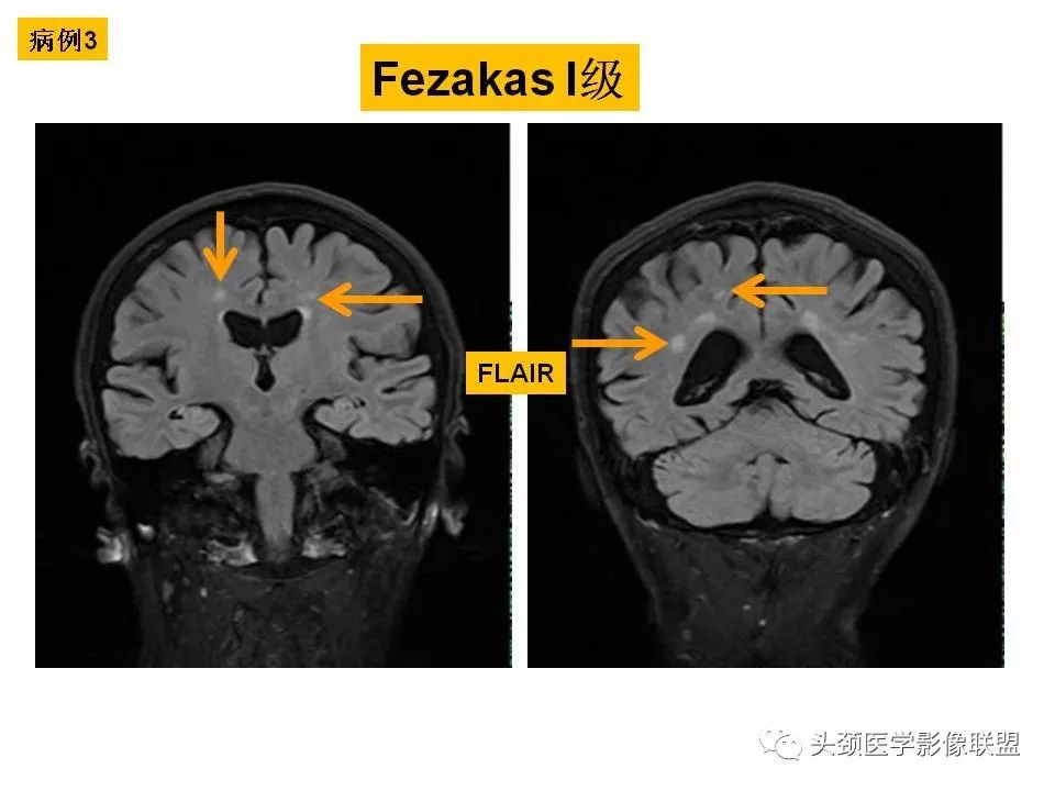 影像PPT - 【PPT】颅脑解剖及血管性病变的MRI诊断-37