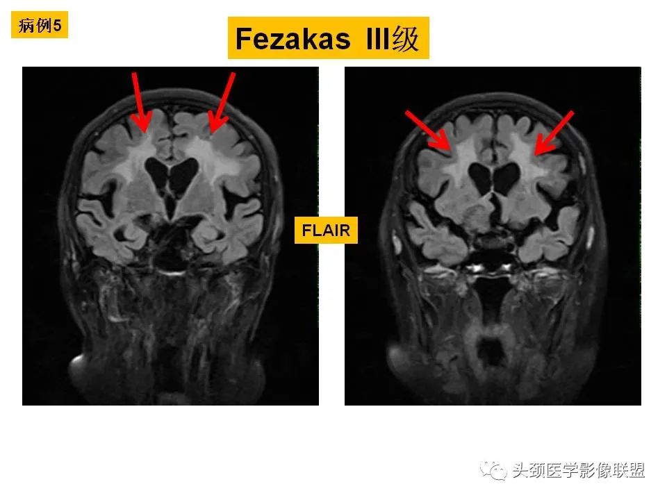 影像PPT - 【PPT】颅脑解剖及血管性病变的MRI诊断-39