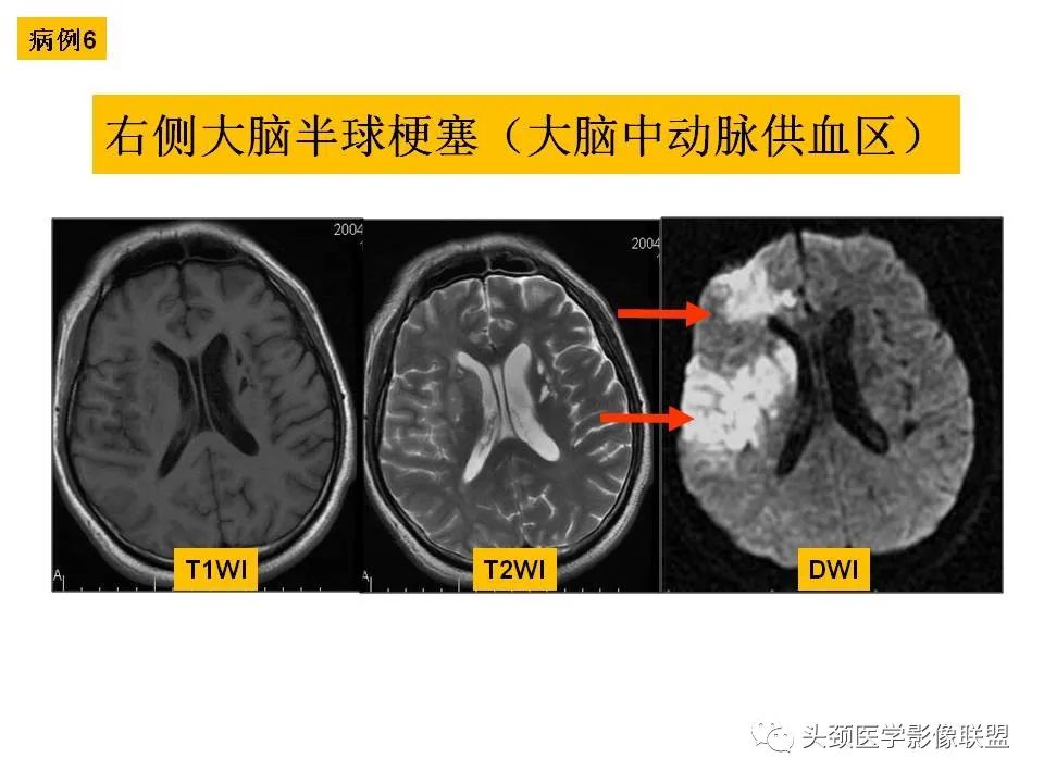 影像PPT - 【PPT】颅脑解剖及血管性病变的MRI诊断-51