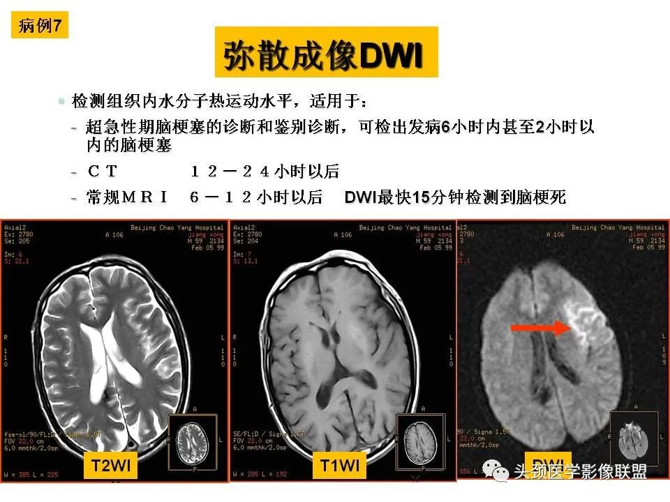 影像PPT - 【PPT】颅脑解剖及血管性病变的MRI诊断-52