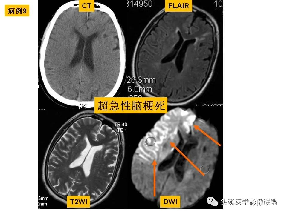 影像PPT - 【PPT】颅脑解剖及血管性病变的MRI诊断-54